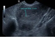 Endometrial Polip Nedir?
