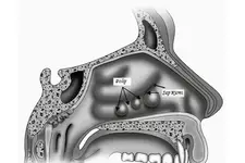 Burunda Polip Belirtileri ve Tedavisi