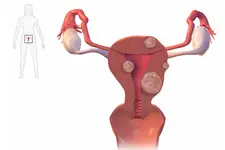 Polip Nedir? Polip Oluşma Nedenleri